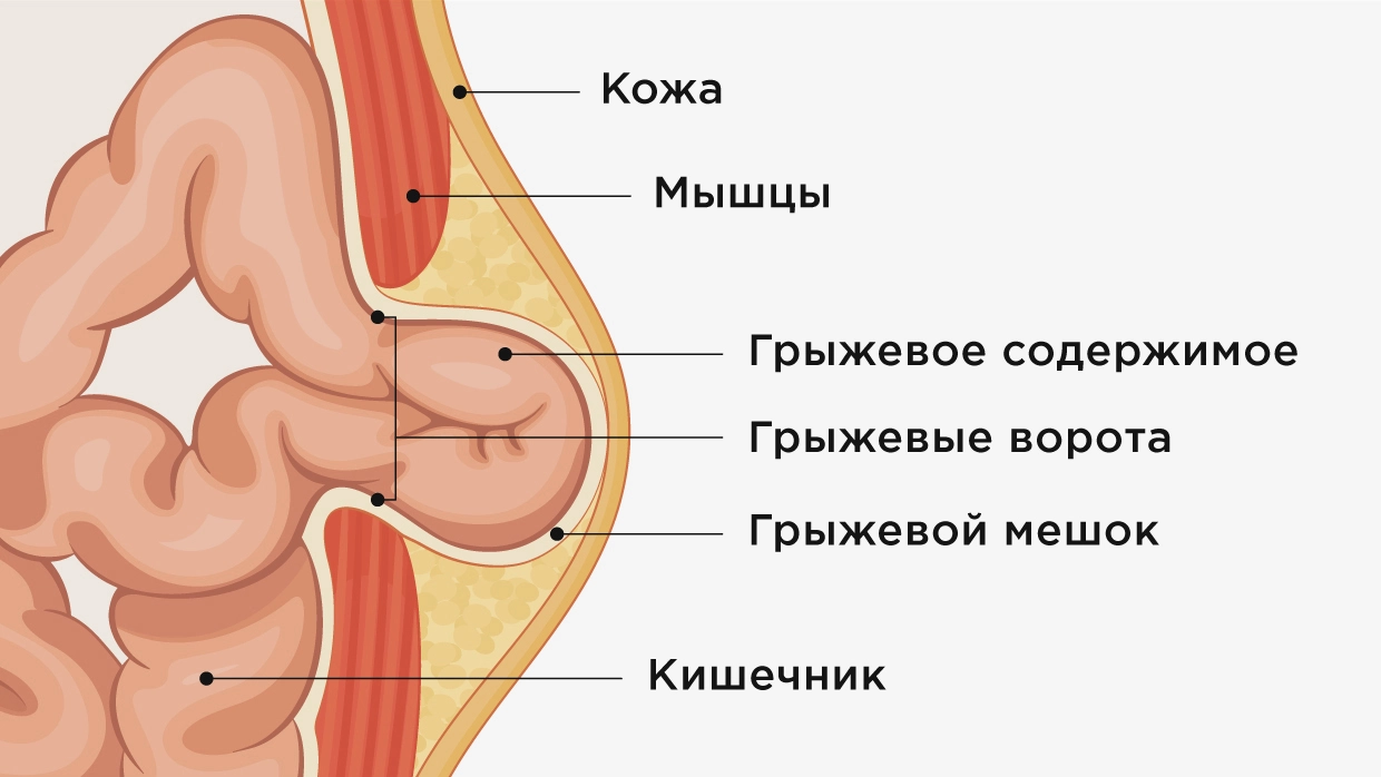 Послеоперационная грыжа - причины образования, лечение и восстановление